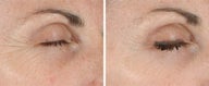 Ultherapy