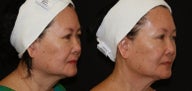 Ultherapy