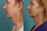 Ultherapy