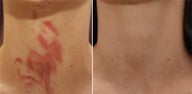 Vbeam for Redness/Bruising Post Accident