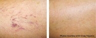 Vbeam vein removal