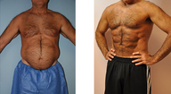 Vaser Liposuction