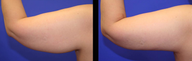 Vaser Liposuction