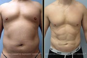 VASER LipoSelection and HiDef Liposculpture