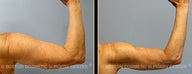 Vaser Liposuction