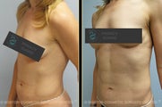 Vaser Liposuction
