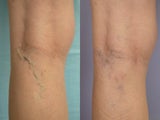 Laser Vein