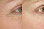 Wrinkle Treatment