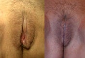Before & After Labiaplasty Surgery (labia minora reduction) 