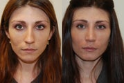 Rhinoplasty Surgery. 6 months post-op.
