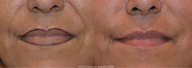 Juvederm Ultra XC for treatment of smile lines 