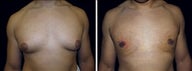 22 year old male, male breast reduction