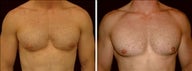 25 year old male, male breast reduction