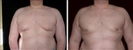 17 year old male, male breast reduction