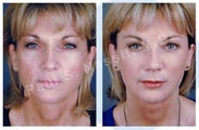 Facelift