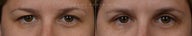 Before and After Bilateral Upper Eyelid Blepharoplasty