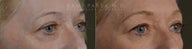 Before and After upper and lower eyelid blepharoplasty