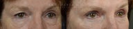 Before and After bilateral upper lower blepharoplasty, canthoplasty