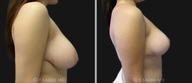 Breast Reduction