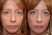Lower eyelid rejuvenation with Silikon-1000