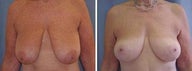 61 years old / breast reduction