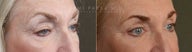 before after bilateral upper lower eyelid blepharoplasty ptosis repair