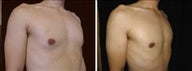 34 year old male, male breast reduction