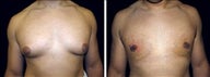 24 year old male, male breast reduction