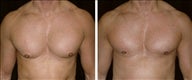 45 year old male, male breast reduction