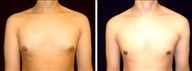18 year old male, male breast reduction