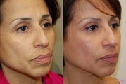 Silikon-1000 and Botox.
