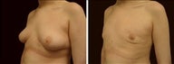 15 year old male, male breast reduction