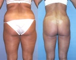 Liposuction