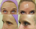 Botox