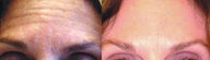 Botox