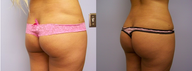 Brazilian butt lift