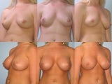 Breast Augmentation