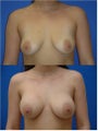 Breast Augmentation