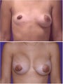 Breast Augmentation