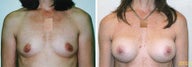 Breast Augmentation