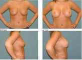 Breast Augmentation