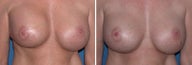 Breast Implants