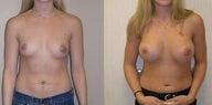 Breast Implants