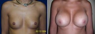 Breast Implants