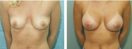 Breast Implants