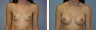 Breast Implants