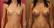 Breast Implants