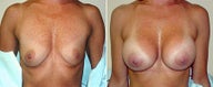 Breast Implants