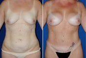 Breast Implants