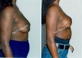Breast lift